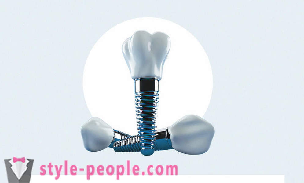 8 întrebări despre implanturi dentare