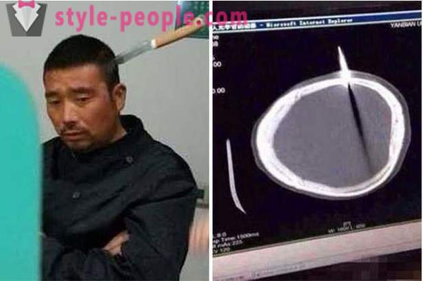 Un bărbat chinez cu un cuțit în cap sa dus la doctor