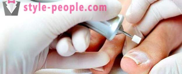 Unghii incarnate pe degetul mare: cauze si tratament